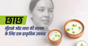 छाछ: मुँहासे और त्वचा की जलन के लिए एक प्राकृतिक उपचार