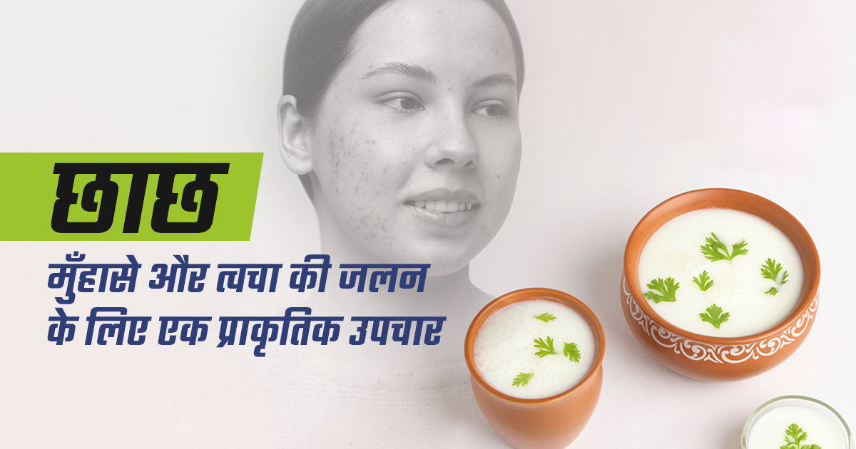 छाछ: मुँहासे और त्वचा की जलन के लिए एक प्राकृतिक उपचार